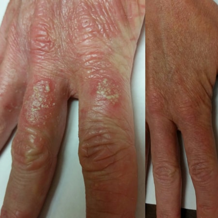 Pompholyx eczema